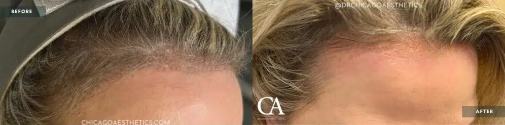 permanent makeup removal before and after photo by chicago aesthetics surgery & med spa in chicago, il