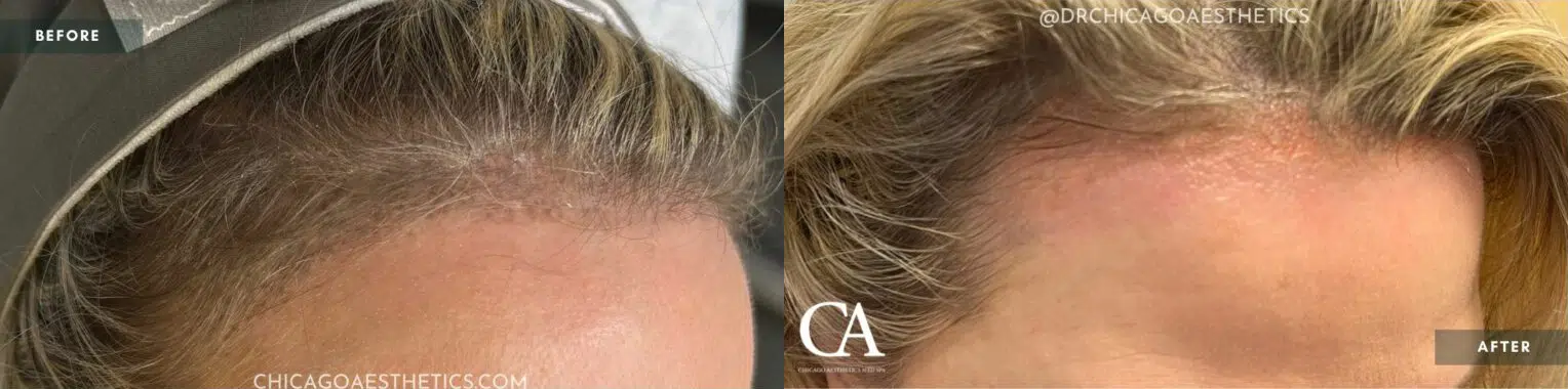 permanent makeup removal before and after photo by chicago aesthetics surgery & med spa in chicago, il