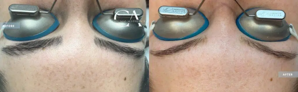 permanent makeup removal before and after photo by chicago aesthetics surgery & med spa in chicago, il