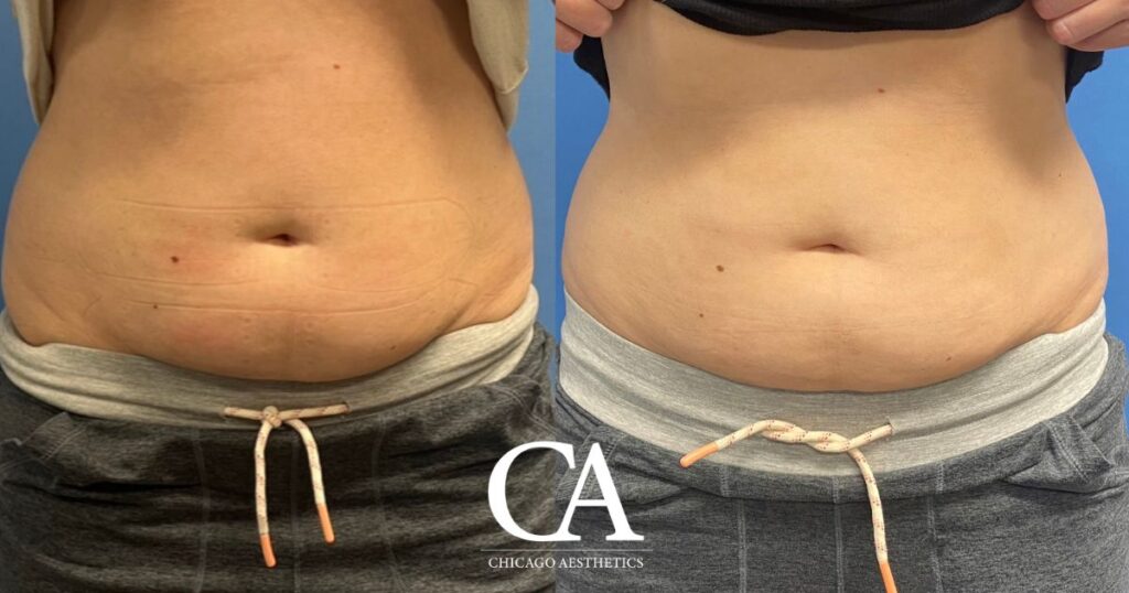 sculpsure before and after photo by chicago aesthetics surgery & med spa in chicago, il