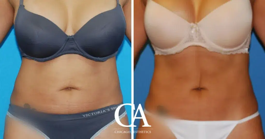 sculpsure before and after photo by chicago aesthetics surgery & med spa in chicago, il