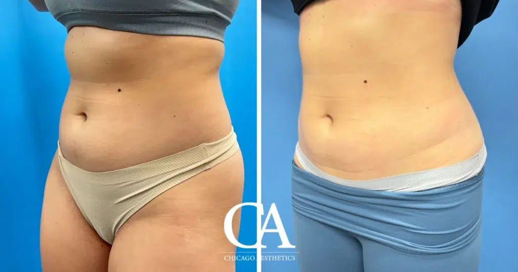 sculpsure before and after photo by chicago aesthetics surgery & med spa in chicago, il