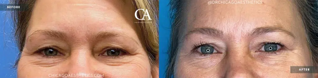 sofwave before and after photo by chicago aesthetics surgery & med spa in chicago, il
