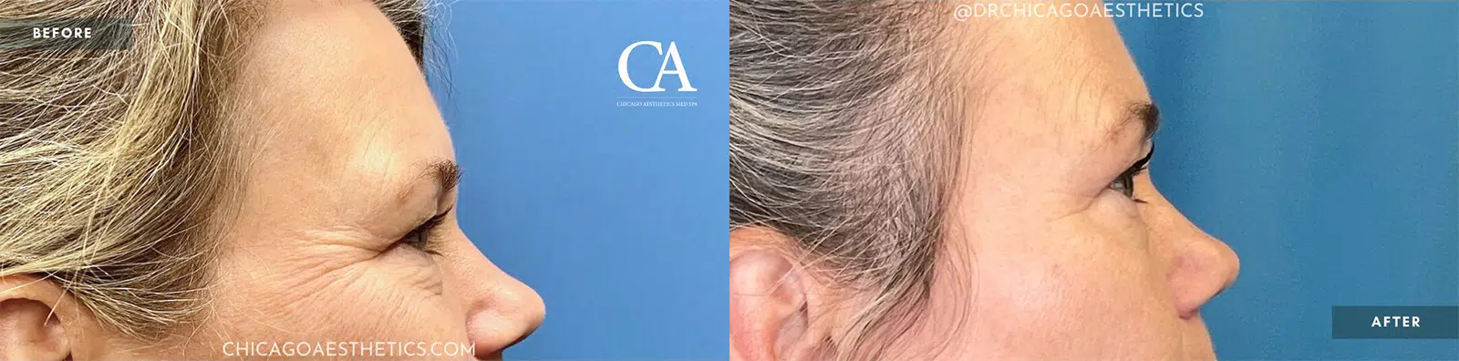 sofwave before and after photo by chicago aesthetics surgery & med spa in chicago, il