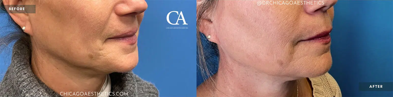 sofwave before and after photo by chicago aesthetics surgery & med spa in chicago, il