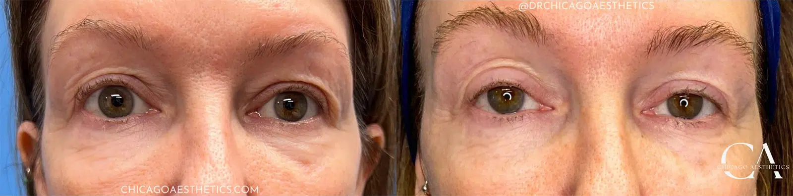 sofwave before and after photo by chicago aesthetics surgery & med spa in chicago, il