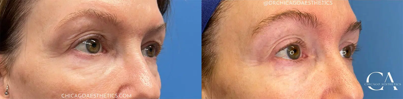 sofwave before and after photo by chicago aesthetics surgery & med spa in chicago, il