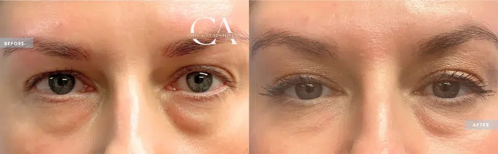 sofwave before and after photo by chicago aesthetics surgery & med spa in chicago, il