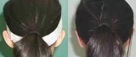 otoplasty before and after photo by chicago aesthetics surgery & med spa in chicago, il