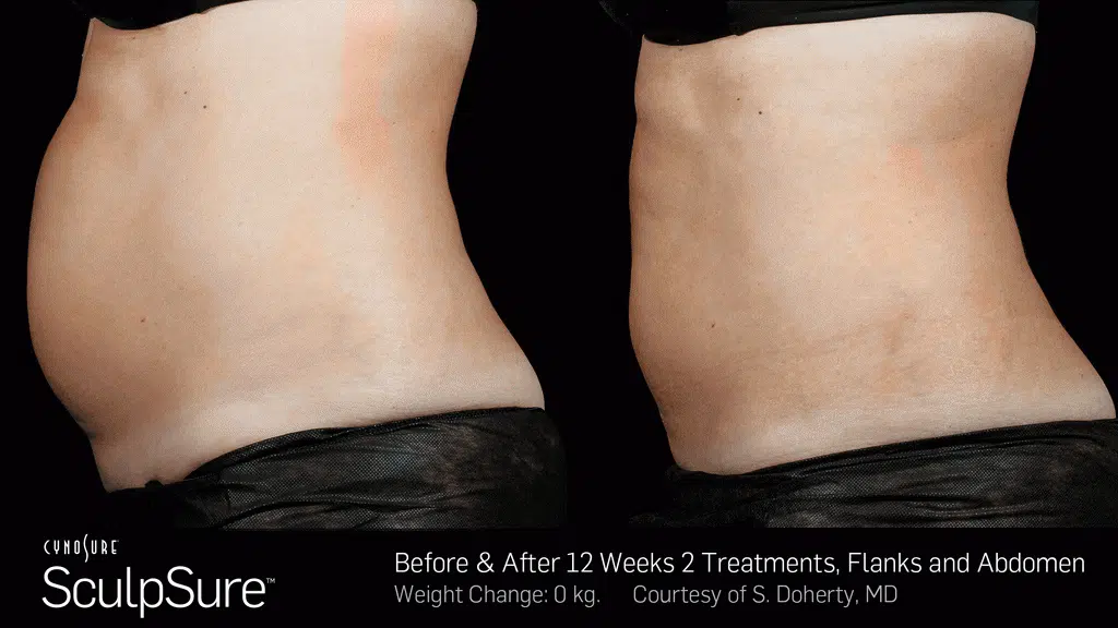 Sculpsure Before After Photos