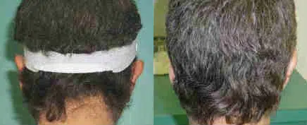 otoplasty before and after photo by chicago aesthetics surgery & med spa in chicago, il