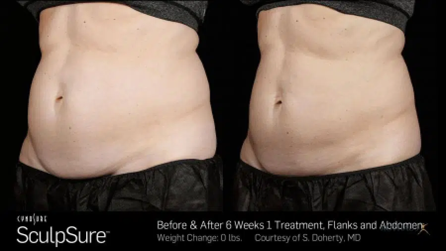 Tummy Tuck Before And After.