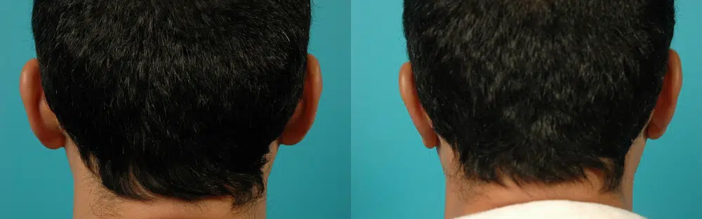 otoplasty before and after photo by chicago aesthetics surgery & med spa in chicago, il