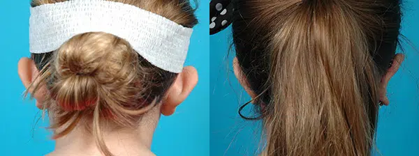 otoplasty before and after photo by chicago aesthetics surgery & med spa in chicago, il
