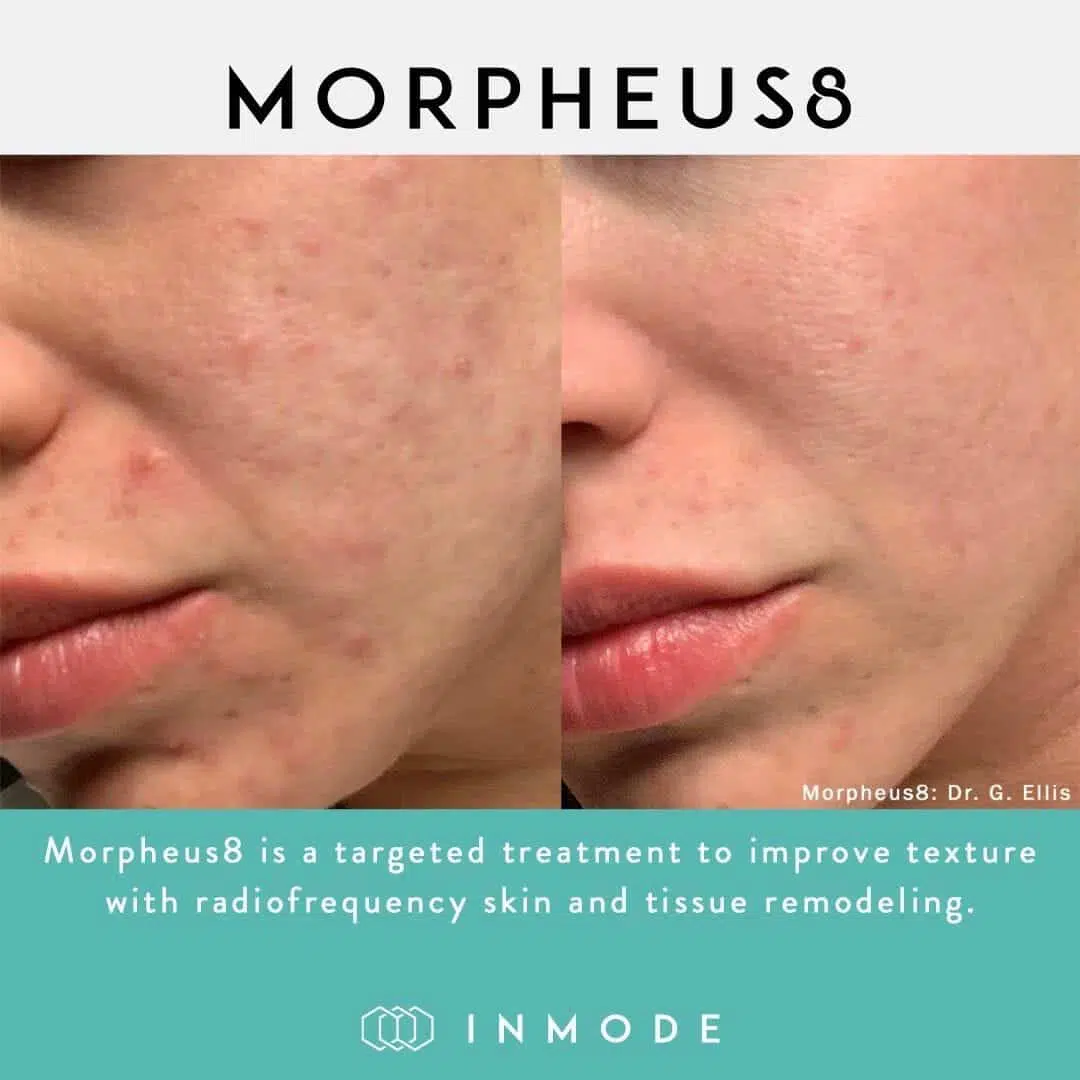 Morpheus8 Acne Treatment