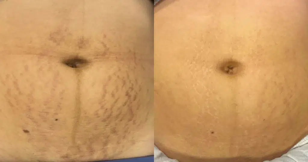 stretch mark removal before and after photo by chicago aesthetics surgery & med spa in chicago, il