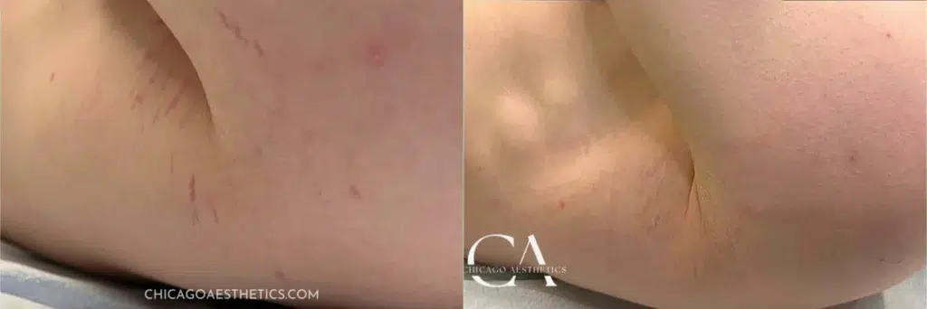 stretch mark removal before and after photo by chicago aesthetics surgery & med spa in chicago, il