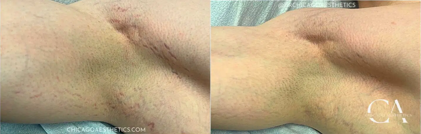 stretch mark removal before and after photo by chicago aesthetics surgery & med spa in chicago, il