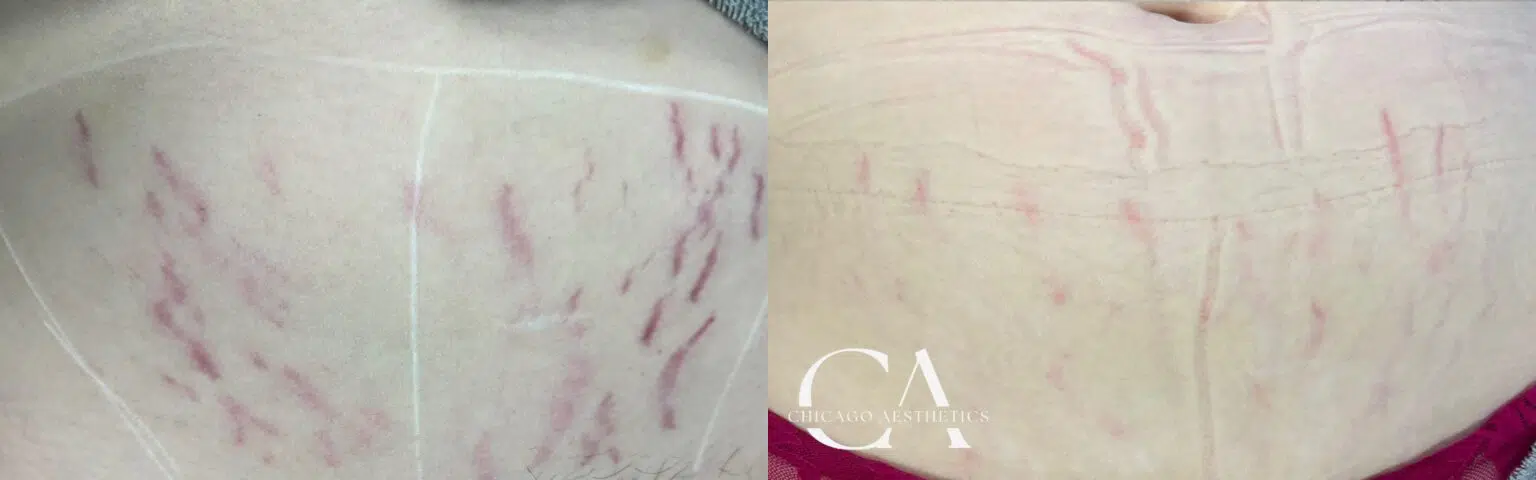 stretch mark removal before and after photo by chicago aesthetics surgery & med spa in chicago, il