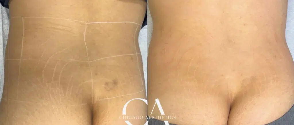 stretch mark removal before and after photo by chicago aesthetics surgery & med spa in chicago, il