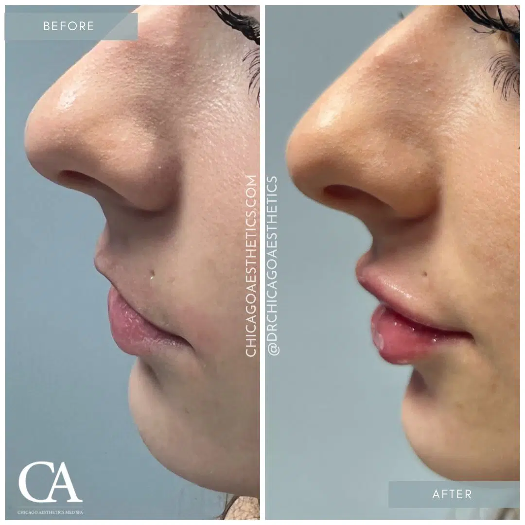 #308 Lip Filler Injections Before After Chicago Aesthetics
