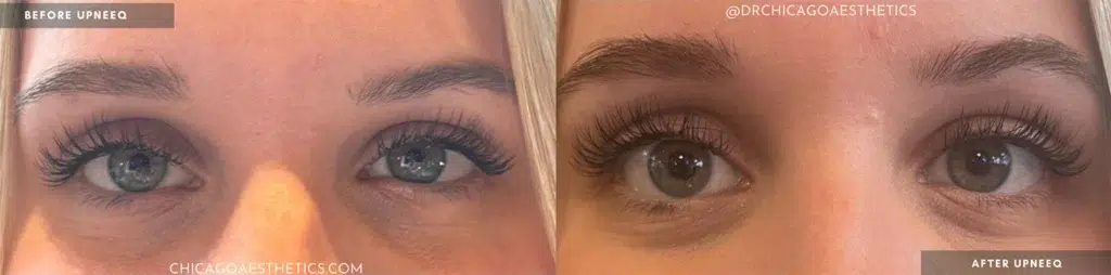 upneeq before and after photo by chicago aesthetics surgery & med spa in chicago, il