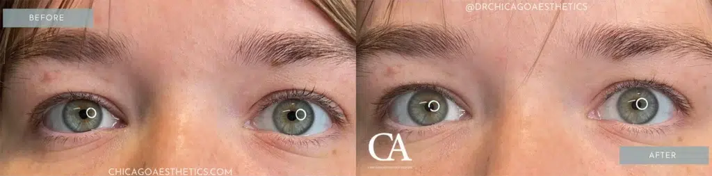 upneeq before and after photo by chicago aesthetics surgery & med spa in chicago, il