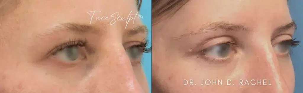 eyelid surgery before and after photo by chicago aesthetics surgery & med spa in chicago, il