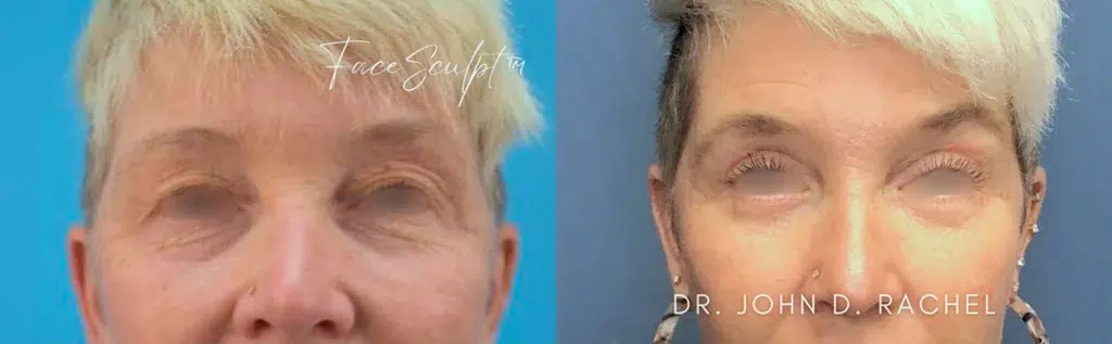 eyelid surgery before and after photo by chicago aesthetics surgery & med spa in chicago, il