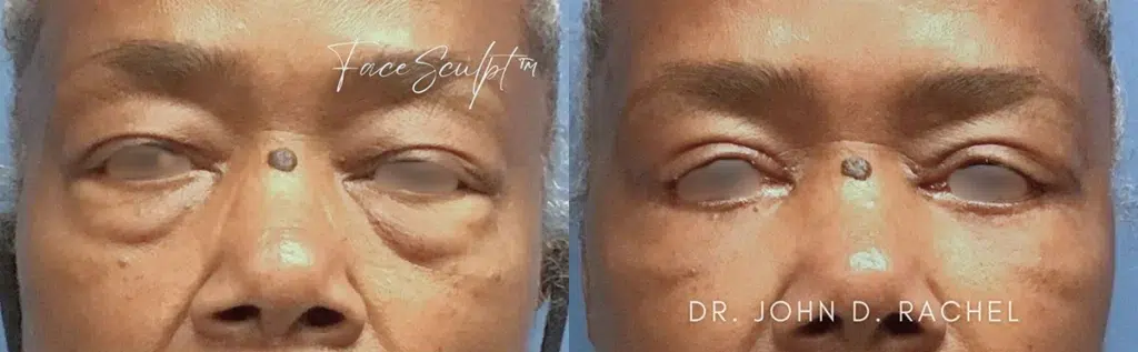 eyelid surgery before and after photo by chicago aesthetics surgery & med spa in chicago, il
