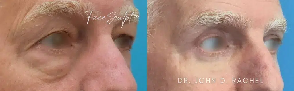 eyelid surgery before and after photo by chicago aesthetics surgery & med spa in chicago, il