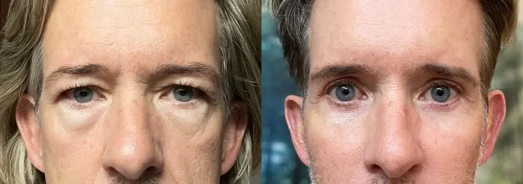 eyelid surgery before and after photo by chicago aesthetics surgery & med spa in chicago, il