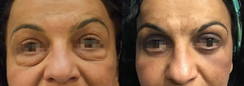 eyelid surgery before and after photo by chicago aesthetics surgery & med spa in chicago, il