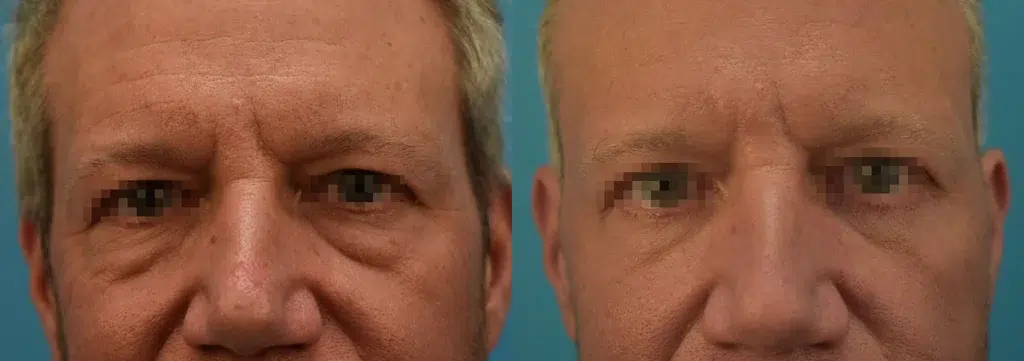 eyelid surgery before and after photo by chicago aesthetics surgery & med spa in chicago, il