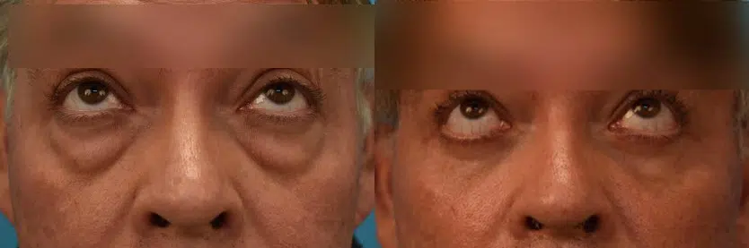 eyelid surgery before and after photo by chicago aesthetics surgery & med spa in chicago, il
