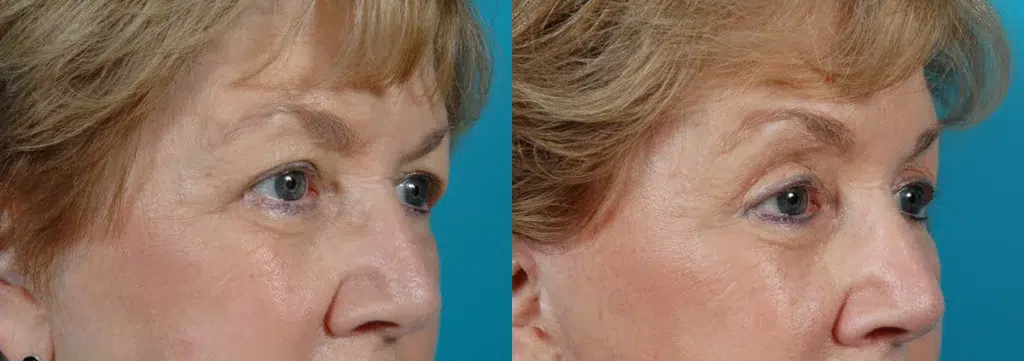 eyelid surgery before and after photo by chicago aesthetics surgery & med spa in chicago, il