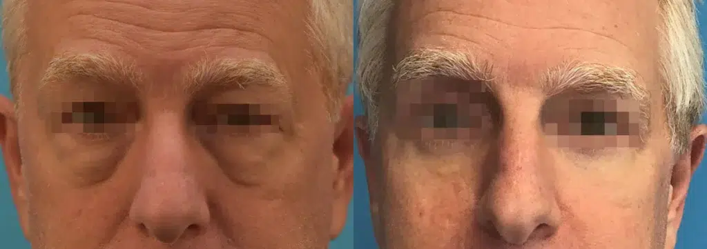 eyelid surgery before and after photo by chicago aesthetics surgery & med spa in chicago, il