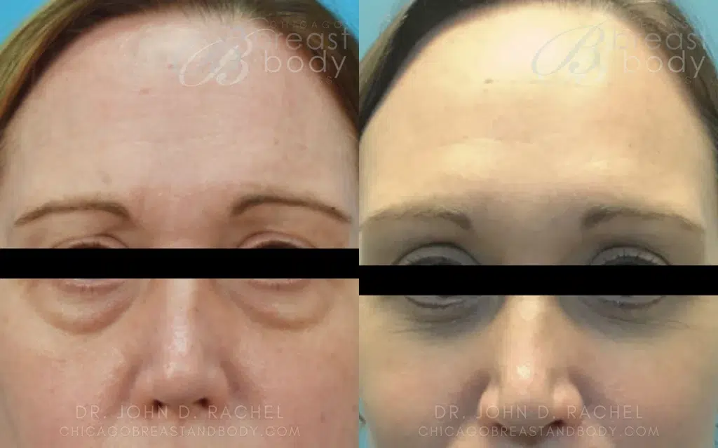 eyelid surgery before and after photo by chicago aesthetics surgery & med spa in chicago, il