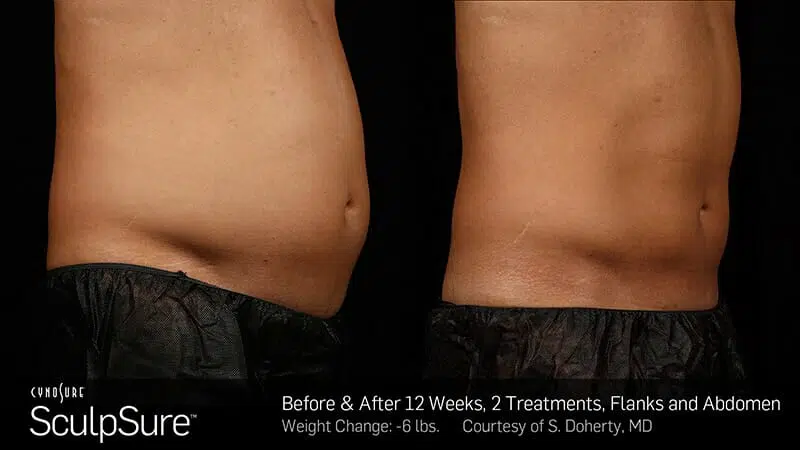 Tummy Tuck Before And After.