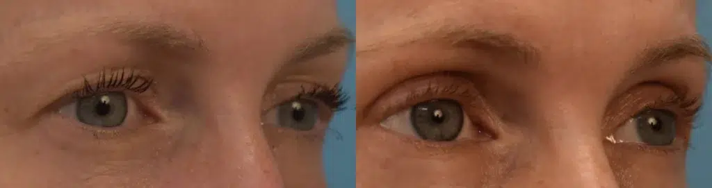 eyelid surgery before and after photo by chicago aesthetics surgery & med spa in chicago, il