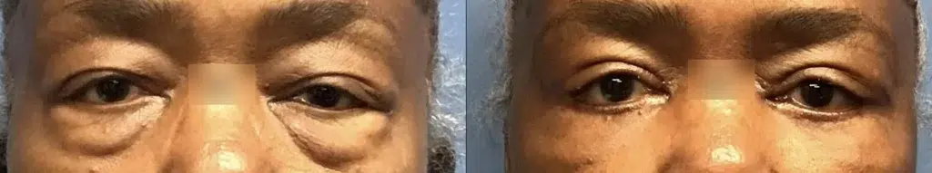 eyelid surgery before and after photo by chicago aesthetics surgery & med spa in chicago, il