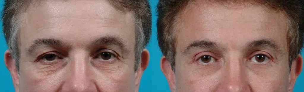 eyelid surgery before and after photo by chicago aesthetics surgery & med spa in chicago, il