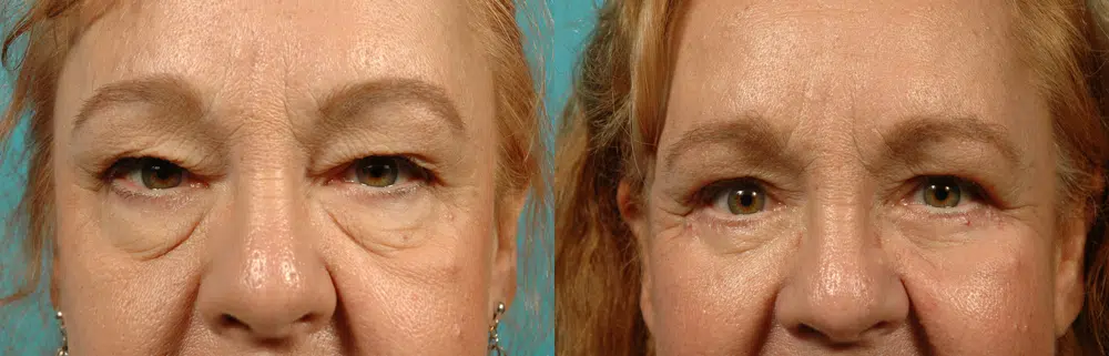 eyelid surgery before and after photo by chicago aesthetics surgery & med spa in chicago, il