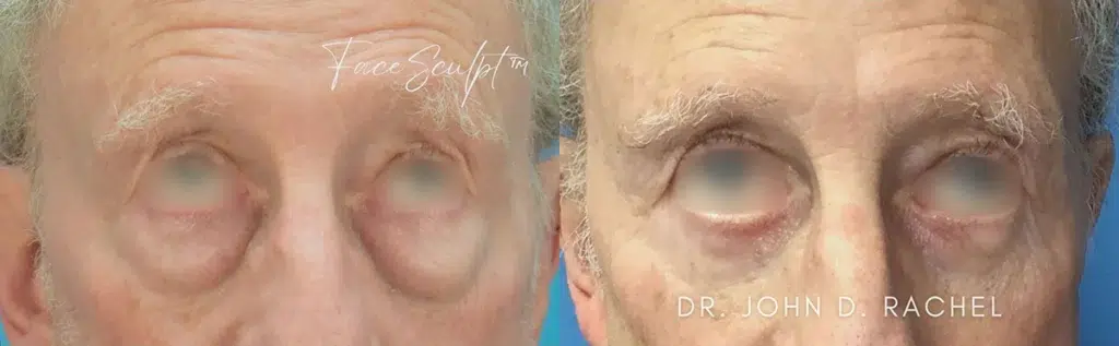 eyelid surgery before and after photo by chicago aesthetics surgery & med spa in chicago, il