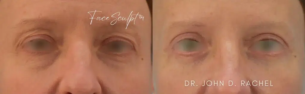 eyelid surgery before and after photo by chicago aesthetics surgery & med spa in chicago, il