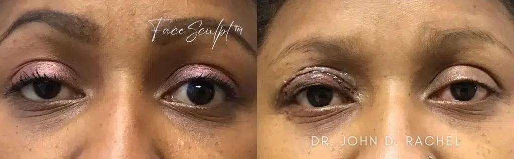 eyelid surgery before and after photo by chicago aesthetics surgery & med spa in chicago, il