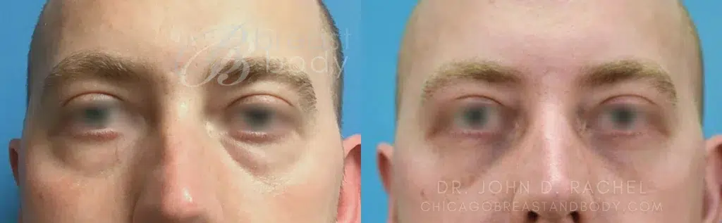 eyelid surgery before and after photo by chicago aesthetics surgery & med spa in chicago, il