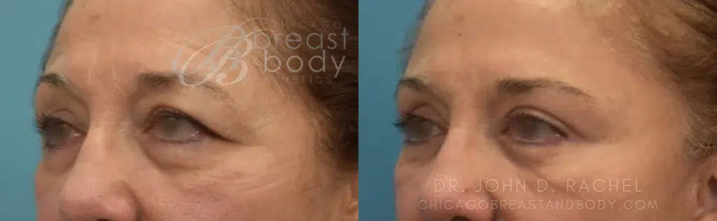 eyelid surgery before and after photo by chicago aesthetics surgery & med spa in chicago, il