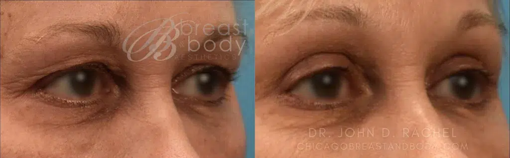 eyelid surgery before and after photo by chicago aesthetics surgery & med spa in chicago, il