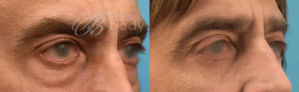 eyelid surgery before and after photo by chicago aesthetics surgery & med spa in chicago, il